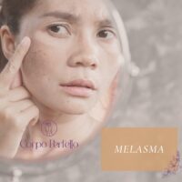 Melasma – O que é? Qual é o seu tratamento?